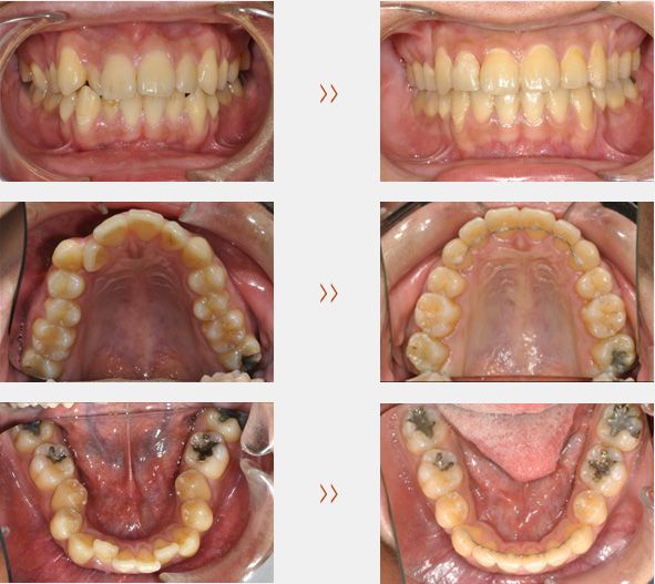 齒顎矯正 齒顎矯正