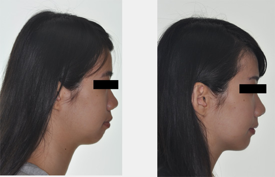 齒顎矯正 齒顎矯正