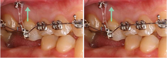 齒顎矯正 齒顎矯正