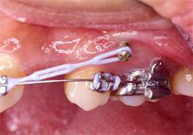 齒顎矯正 齒顎矯正